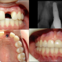 Implantes dentales sin costo de honorarios